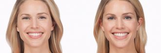 Botox antes y después